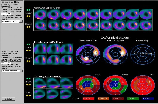 Hình 2 5 Trình bày hình ảnh xạ hình tưới máu cơ tim Kết quả XHTMCT được 3