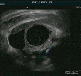 Tổn thương ống tụy sỏi ống tụy chính giãn ống tụy thành của ống tụy 1