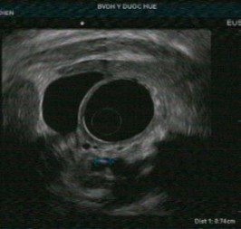 Tổn thương ống tụy sỏi ống tụy chính giãn ống tụy thành của ống tụy 2