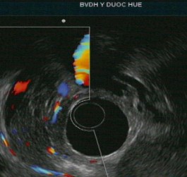 Tổn thương ống tụy ống tụy chính không giãn nhưng có tăng âm thành ống tụy 3