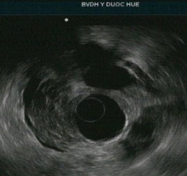 Tổn thương ống tụy ống tụy chính không giãn nhưng có tăng âm thành ống tụy 4