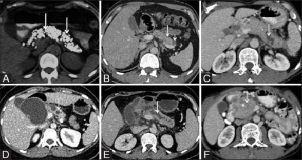 Hình 1 4 Tổn thương tụy trên cắt lớp vi tính A Sỏi tụy B Tụy teo nhỏ và nang 1