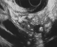 Thành ống tụy chính không đều Sỏi ống tụy chính Hình 2 8 Các hình ảnh viêm 1