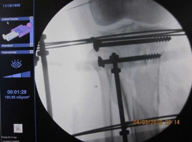 Hình 2 9 Màn hình máy C arm cho thấy các mảnh gãy đã được nắn và cố định 2