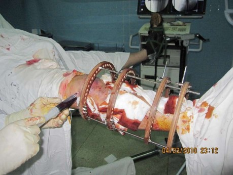 Hình 2 10 Chọc hút máu tụ trong khớp gối khi kết thúc cuộc mổ 2 5 1 4 Đánh giá 3