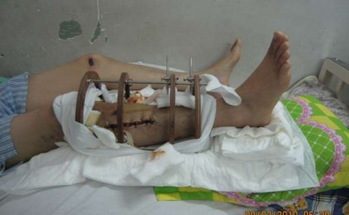 Hình 2 11 Chân bệnh nhân được kê cao và cho tập gồng cơ tập gấp duỗi khớp 4