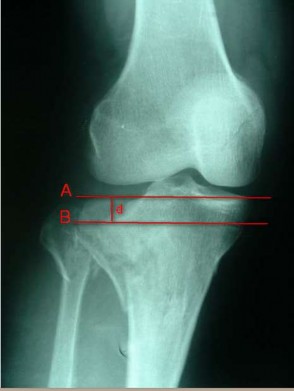 Hình 2 12 Cách xác định độ lún mâm chày trên X quang 2 6 2 2 Độ tăng bề rộng 39