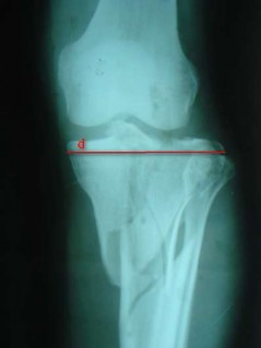 Hình 2 13 Cách xác định bề rộng mâm chày ở chân gãy Hình 2 14 Cách xác định 40