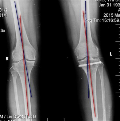 Hình 2 14 Cách xác định góc chày đùi 2 6 2 3 Góc chày đùi và độ khác biệt góc 41