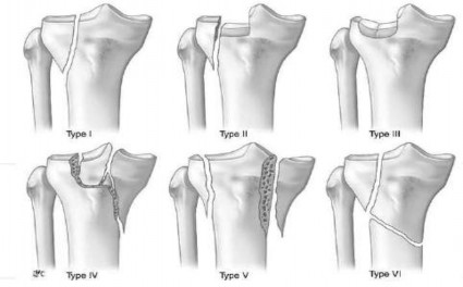 Hình 1 5 Phân loại gãy mâm chày của Schatzker Nguồn Cristea Şt et al The role of 2