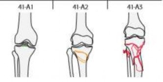 Hình 1 6 Phân loại gãy đầu trên xương chày theo AO – ASIF Nguồn AO Foundation 3