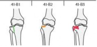 Hình 1 6 Phân loại gãy đầu trên xương chày theo AO – ASIF Nguồn AO Foundation 4