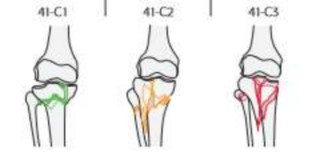 Hình 1 6 Phân loại gãy đầu trên xương chày theo AO – ASIF Nguồn AO Foundation 5