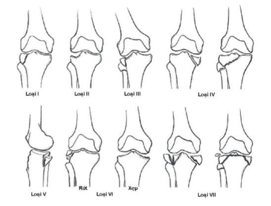 Hình 1 7 Phân loại gãy mâm chày của Hohl năm 1991 Nguồn Wiss D A Rockwood and Green 39 6