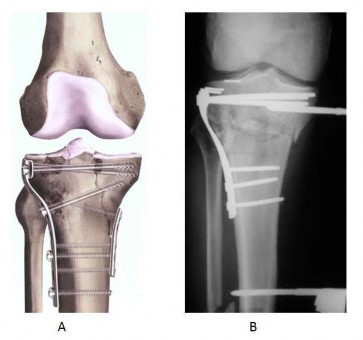 Hình 1 8 Nẹp nhỏ chống trượt A hoặc cố định ngoài B dùng để thay thế nẹp 1
