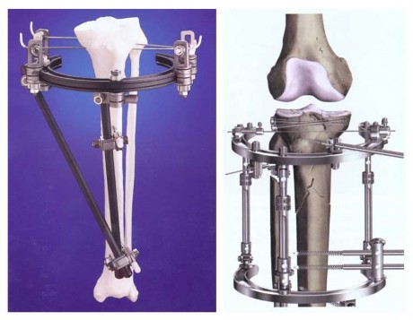 Hình 1 9 Hai loại khung cố định ngoài hybrid được dùng điều trị gãy mâm chày 1