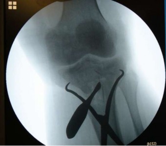 Hình 1 10 Kỹ thuật nắn kín nâng chỗ lún mâm chày Nguồn Hall J A Beuerlein M J McKee 2