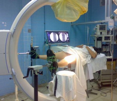 Hình 2 3 Bệnh nhân nằm trên bàn chỉnh hình chân tổn thương được kéo dọc 4