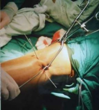 Hình 2 4 Kỹ thuật nắn xương bằng cách dùng kìm có mấu nhọn để ép mảnh gãy 1