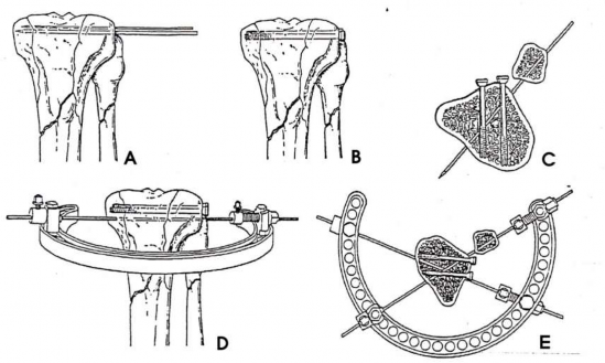 Hình 2 5 Vị trí bắt vít xốp và xuyên đinh Kirschner Nguồn Stamer D T Schenk R 2