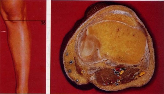 Hình 2 6 Mặt cắt ngang qua hai mâm chày hướng xuyên đinh an toàn là 100 o 310 o và 3