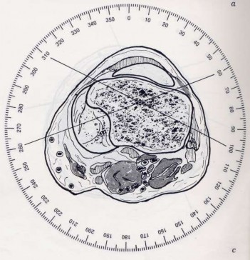 Hình 2 6 Mặt cắt ngang qua hai mâm chày hướng xuyên đinh an toàn là 100 o 310 o và 4