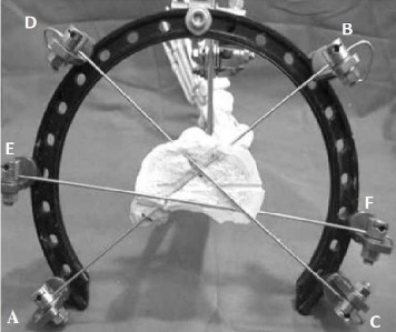 Hình 2 7 Vị trí và hướng của ba đinh Kirschner ở vòng đầu tiên Nguồn El Alfy B 5