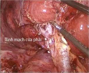 Hình 4 1 PTNS phẫu tích kiểm soát cuống gan trong bao Glisson Bệnh án 44 BN Châu thị 1