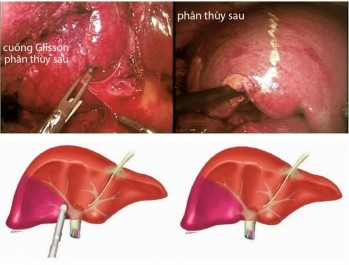 Hình 4 2 PTNS cắt gan phân thùy sau Kỹ thuật tiếp cận cuống Glisson trong gan 2