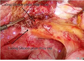 Hình 4 3 Kỹ thuật PTNS kiểm soát cuống gan ngoài bao Glisson Bệnh án 184 BN Nguyễn 1
