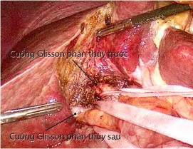 Hình 4 3 Kỹ thuật PTNS kiểm soát cuống gan ngoài bao Glisson Bệnh án 184 BN Nguyễn 2
