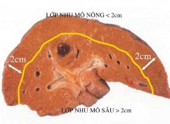 Hình 4 4 Chiến lược sử dụng dụng cụ cắt nhu mô gan theo Kaneko Nguồn Kaneko 2009 3
