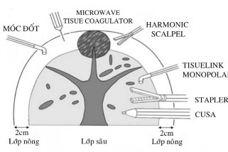 Hình 4 4 Chiến lược sử dụng dụng cụ cắt nhu mô gan theo Kaneko Nguồn Kaneko 2009 4