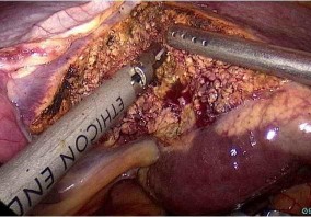 Hình 4 5 Cắt nhu mô gan bằng dao cắt đốt siêu âm Cắt cuống Glisson của thùy 5