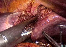 Hình 4 5 Cắt nhu mô gan bằng dao cắt đốt siêu âm Cắt cuống Glisson của thùy 6