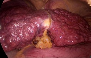 Hình 4 6 PTNS cắt gan HPT 3 ở BN béo phì xơ gan nặng Bệnh án 270 BN Lê thị Thúy H 1