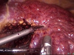 Hình 4 6 PTNS cắt gan HPT 3 ở BN béo phì xơ gan nặng Bệnh án 270 BN Lê thị Thúy H 2