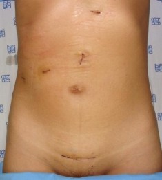 Hình 4 7 Sẹo mổ sau PTNS cắt gan phải 10 ngày Bệnh án 84 BN Quản Thị H SNV 10 1