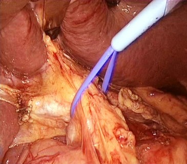 Hình 1 3 Kỹ thuật Pringle kiểm soát toàn bộ cuống gan qua PTNS Bệnh án số 23 BN 1