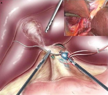 Hình 1 6 Kỹ thuật phẫu tích tiếp cận cuống gan trong bao Glisson Nguồn Tranchart 4