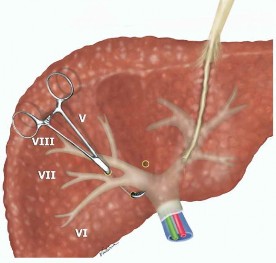 Hình 1 7 Kỹ thuật phẫu tích tiếp cận cuống gan ngoài bao Glisson trong gan Nguồn 1