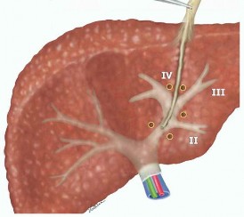 Hình 1 7 Kỹ thuật phẫu tích tiếp cận cuống gan ngoài bao Glisson trong gan Nguồn 2