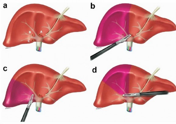 Hình 1 8 Kỹ thuật tiếp cận cuống Glisson ngoài bao trong gan theo Machado Nguồn 3