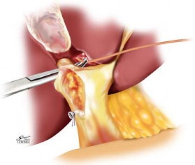 Hình 1 9 Mổ mở kiểm soát cuống gan phân thùy trước và sau ngoài bao Glisson 4