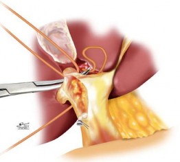 Hình 1 9 Mổ mở kiểm soát cuống gan phân thùy trước và sau ngoài bao Glisson 5