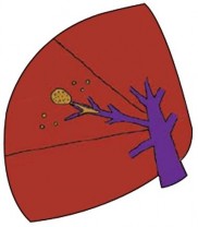 Hình 1 10 Cắt gan theo giải phẫu Nguồn Takasaki 2007 99 Trong mổ mở cắt gan nhiều 1