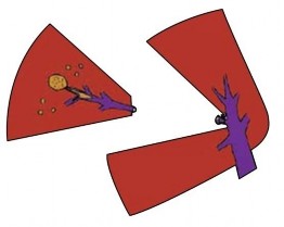 Hình 1 10 Cắt gan theo giải phẫu Nguồn Takasaki 2007 99 Trong mổ mở cắt gan nhiều 2