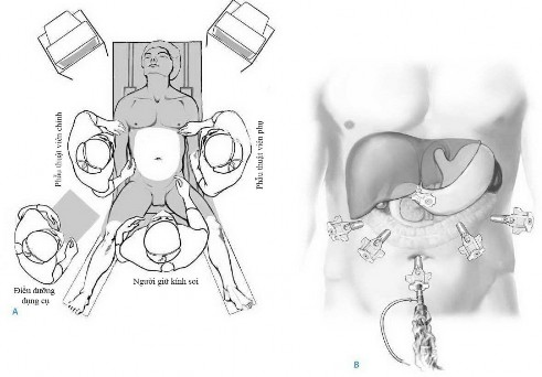 Hình 2 5 Tư thế BN vị trí phẫu thuật viên A vị trí đặt trocar B ―Nguồn 10