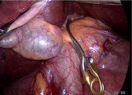 Hình 2 1 Kẹp tạm cuống gan phải bằng Bulldog nội soi ―Bệnh án 259 BN Trần Văn 3