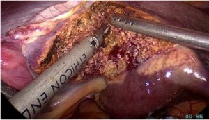 Hình 2 2 Cắt nhu mô gan bằng dao cắt siêu âm Harmonic scalpel ―Bệnh án 190 BN Cao 5